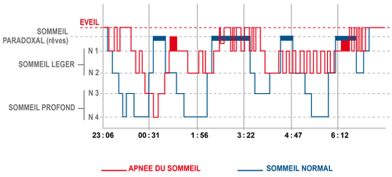 apnée du sommeil effet