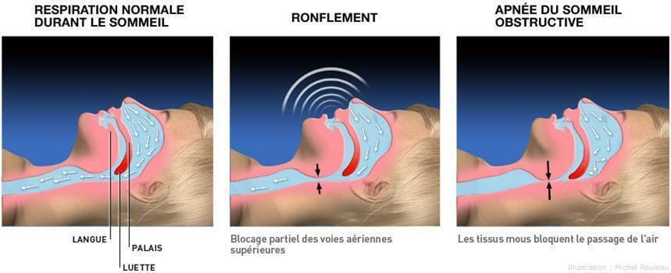 apnée du sommeil schéma